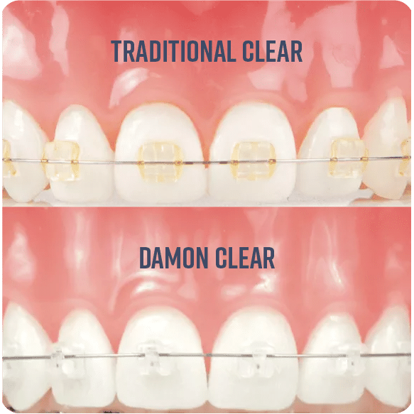 A collaged image showing traditional clear braces on the top compared with damon clear braces at the bottom.