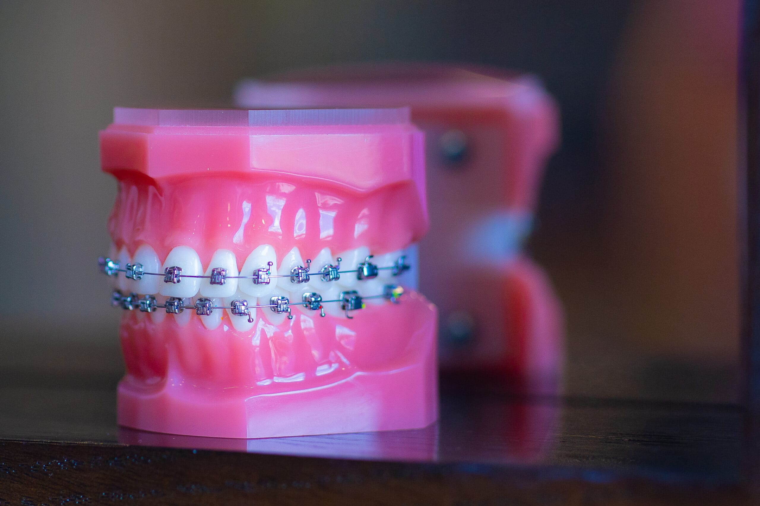 Damon braces on a dental model